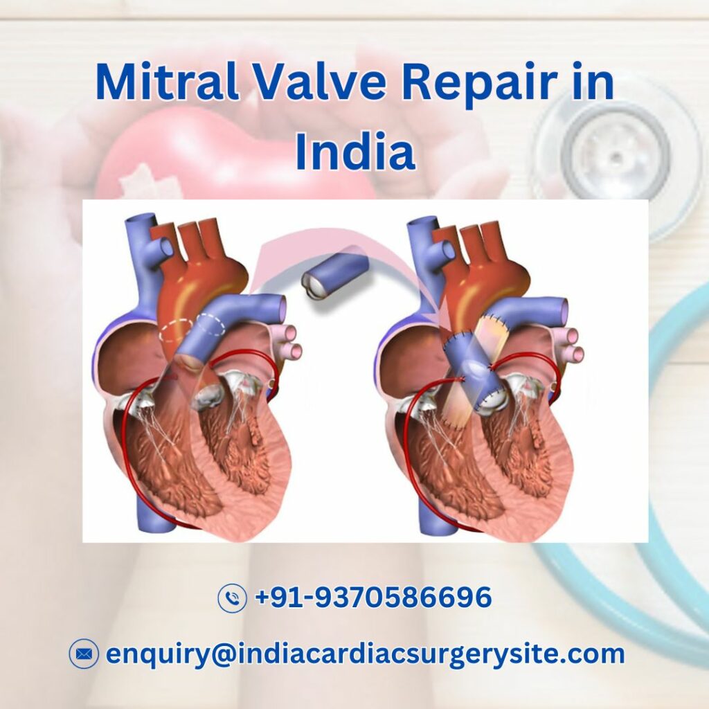 Affordable Mitral Valve Repair in India