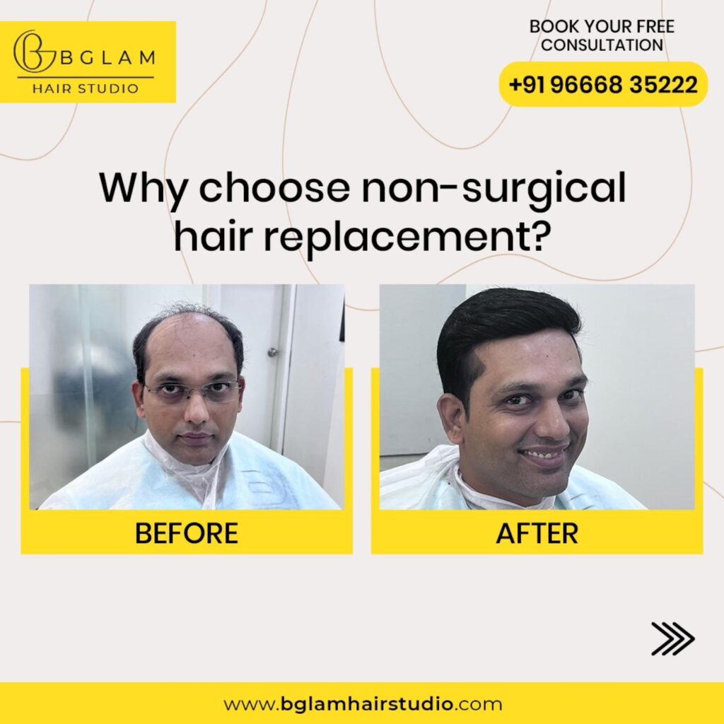 Get non surgical hair replacement for men in Bangalore at Bglam Hair Studio. Natural-looking hair patches, painless fixing & transparent pricing. Book now!